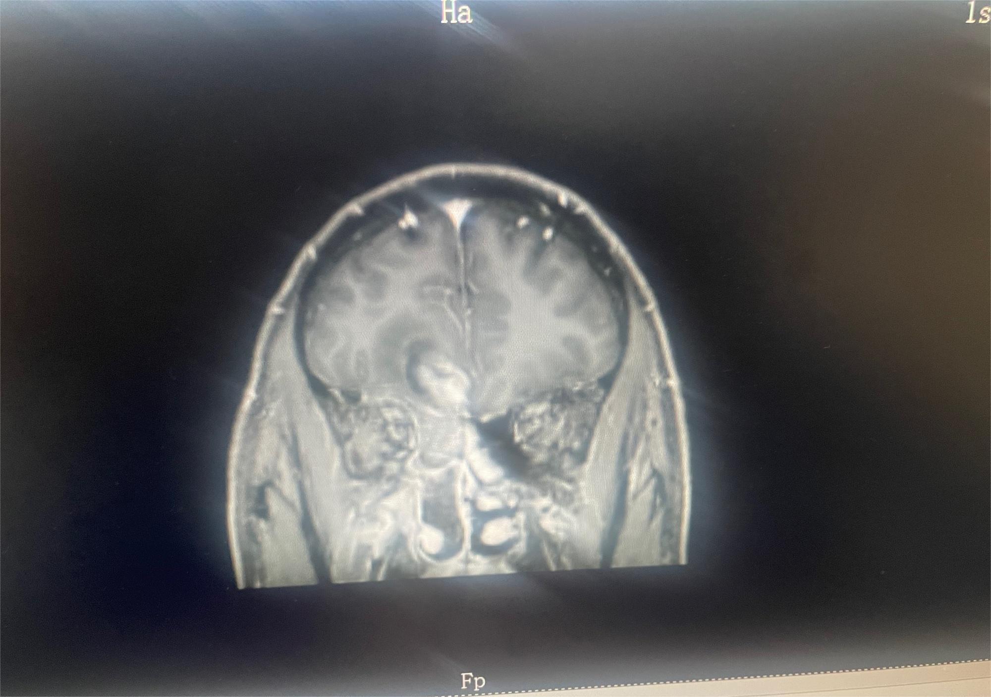 脑部肿瘤求助